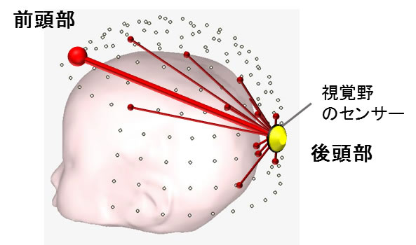 図2：赤い線で示した部位間の脳機能結合（※）が高い自閉症幼児で，視覚的な類推課題の達成度が高いことが分った。