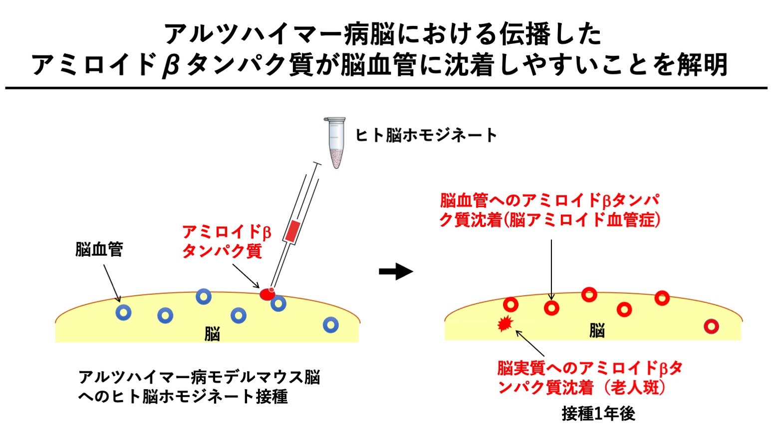 アルツハイマー病の前駆段階とは何ですか?